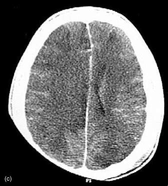 severe head injury anesthesia key