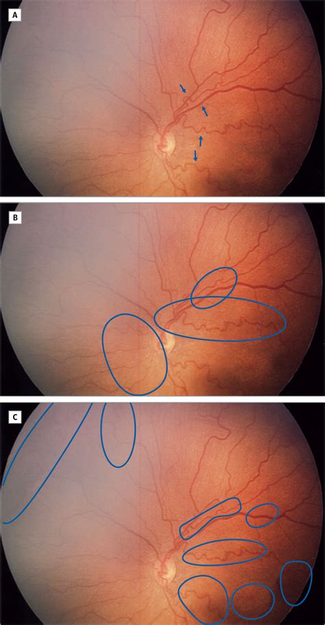disease  retinopathy  prematurity neonatology jama