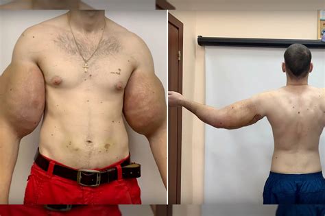 Russian Bodybuilder Popeye Removes 3lbs Of Jelly From Biceps