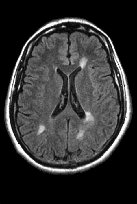 Mri And Ms Diagnosis Does Ms Show Up On Mri Multiple Sclerosis