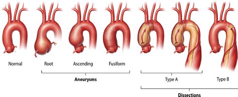 Genetics Of Thoracic And Abdominal Aortic Diseases Circulation Research