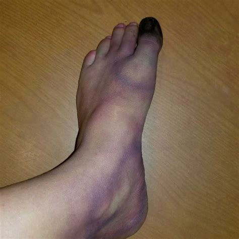 sfx broken foot broken foot