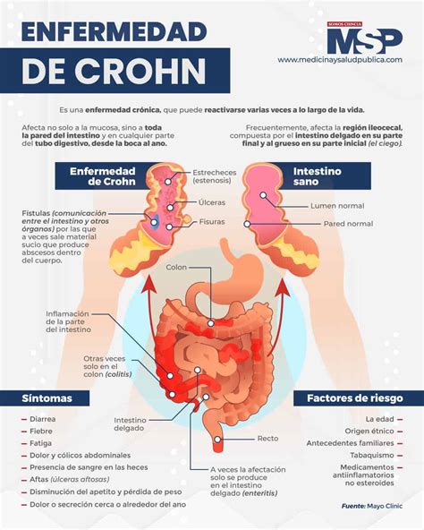 enfermedad de crohn infografia