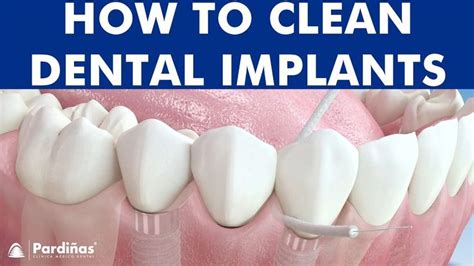 clean dental implants  video  clinica medico dental