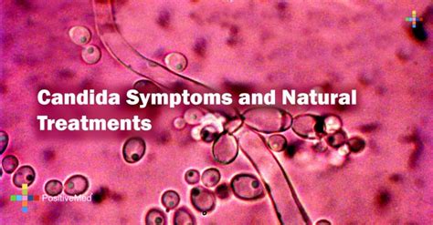 Candida Symptoms And Natural Treatments