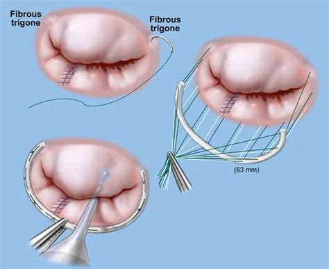 25 Elegant Heart Valve Surgery Risks