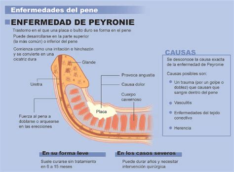 La Curvatura Del Pene Dificulta Las Relaciones Sexuales Y Crea