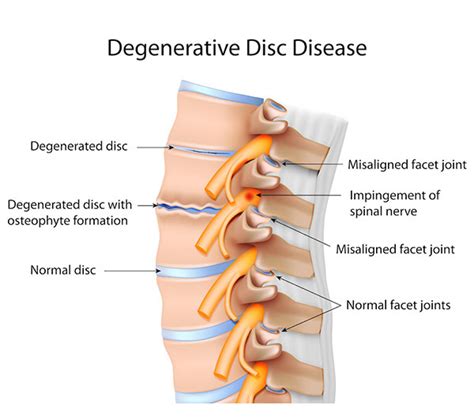 Low Back Pain Facet Joint Syndrome Facet Lock