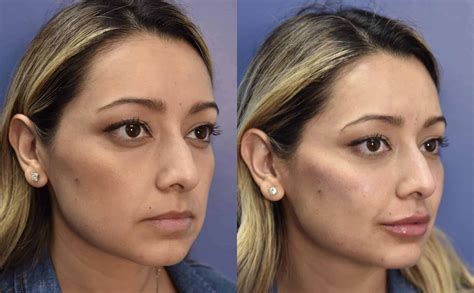 Cheek Filler Results 🥰 Cheek Fillers Face Fillers Facial Plastic