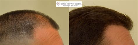 Zizi, oltre 20 anni di esperienza. Risultati Trapianto capelli zona laterale - Istituto Helvetico Sanders