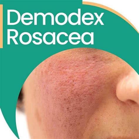 rosacea  demodex mites demodex demodex mites demodex treatment