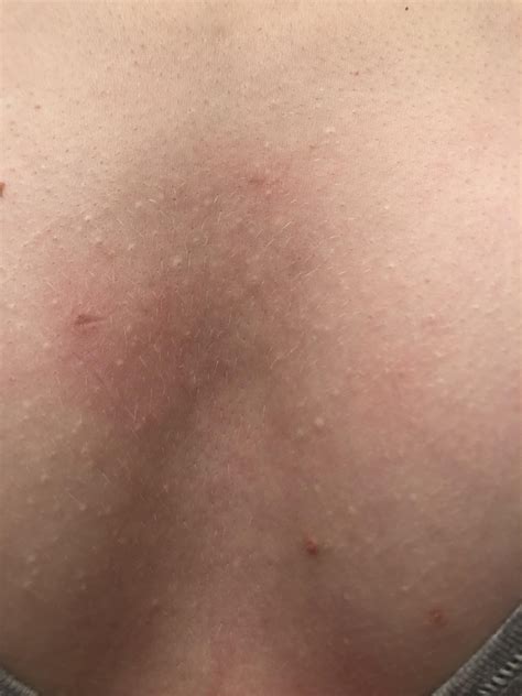 I Have All These Little White Bumps On My Chest Not Itchy