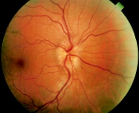 optic neuritis  marked distension   optic nerve sheath due