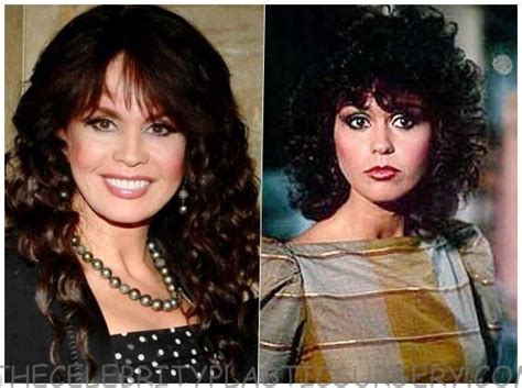 Marie Osmond Before And After Cosmetic Surgery Marie