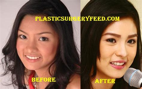 kim chiu plastic surgery plastic surgery feed