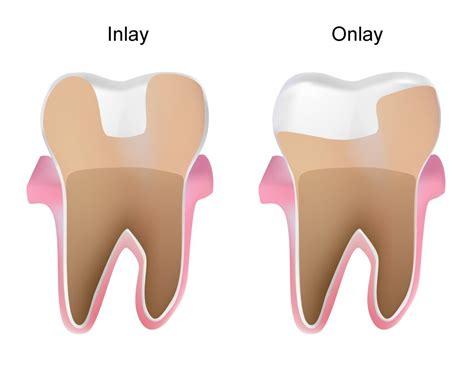 inlays  onlays nashville tn iroquois family dentistry