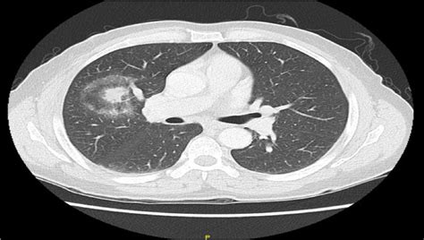 A Chest Ct Scan Showing Right Upper Lobe Mass With Hilar