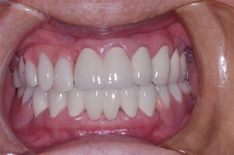 partial dentures  upper front teeth