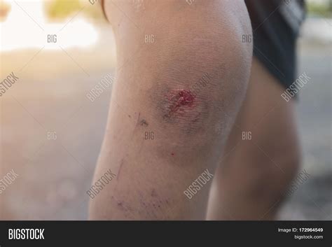 infected wound  leg image photo  trial bigstock