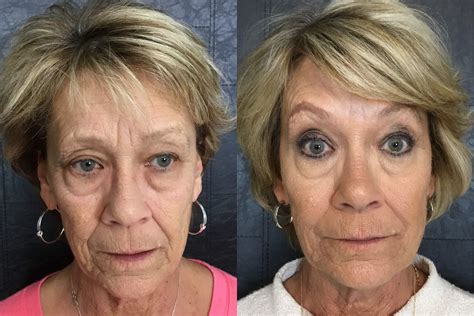 Facial Filler Before And After 01 Bella Vi