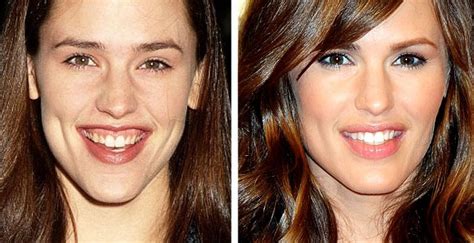 Celebrity Jennifer Garner Before And After Nose Job Best