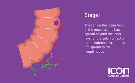 colorectal cancer signs and symtomps icon centre singapore