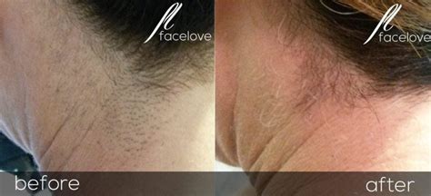 Laser Hair Reduction Facelove
