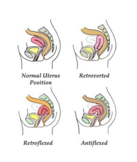 Retroverted Uterus Cervix Position