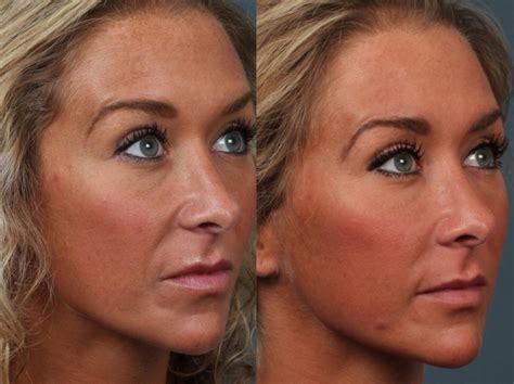 Laser Genesis Treatment Before And After Photos Patient 690 Louisville