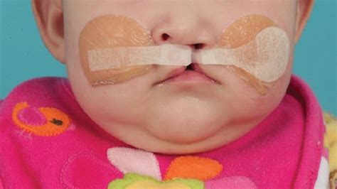 cleft lip features decisions  dentistry