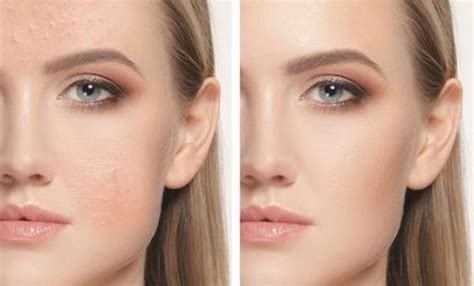 uneven skin tone  pigmentation     treat