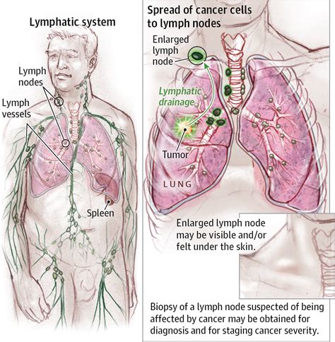 lymph nodes    body examples  forms