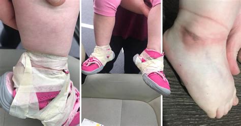 mum horrified after daughter s shoes were taped onto her feet by