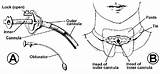 Tracheostomy Tube Parts Elective Surgical Metal Special sketch template