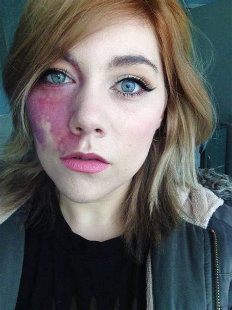 a tv producer thought this woman s birthmark made her ‘too ugly to love