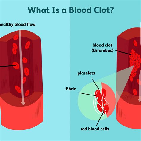 blood clot gif link guru