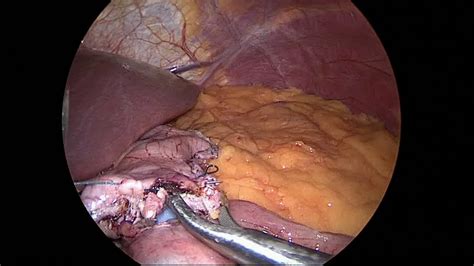 Bariatric Surgery Laparoscopic One Anastomosis Gastric