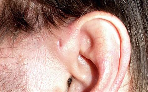 hole  ear preauricular pit
