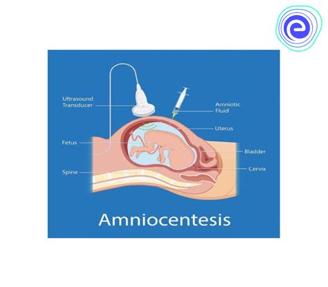 amniocentesis procedure complications and amniotic fluid