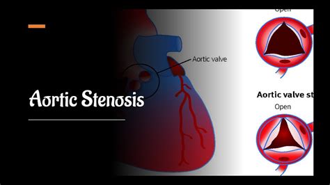 severe aortic stenosis time  intervention youtube