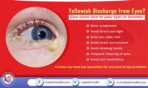 yellowish discharge  eyes give extra care   eyes  summer