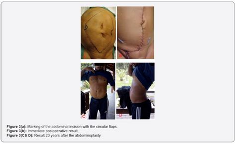 abdominoplasty in prune belly syndrome umbilicus reconstruction using