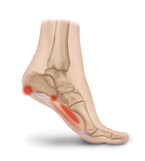 Plantar Fascia Ligament And Pain Conditions Heel That Pain