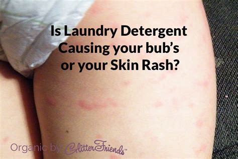 laundry detergent  fabric softener  causing skin irritation  dye  fragrance
