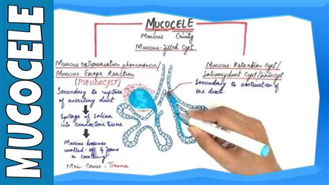 mucous retention cyst lip histology siteliporg