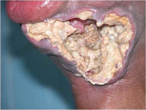 cancer of the mouth with maggots inside
