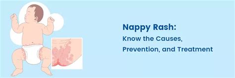 protecting  baby   prevent  treat nappy rash