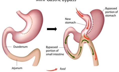 Side Effects Of Gastric Bypass Surgery For Your Health