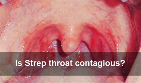 What Are The Symtoms Of Strep Throat Sex Clips