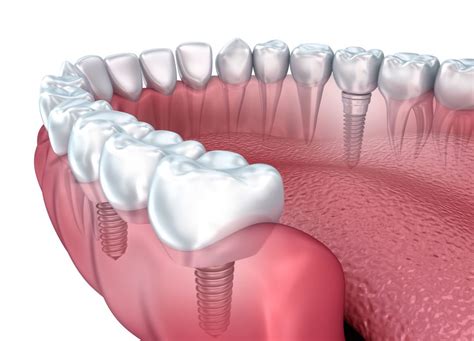 guide  dental implants  popular option  tooth replacement